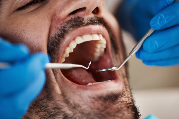 Best Emergency Tooth Extraction in Five Points, NC