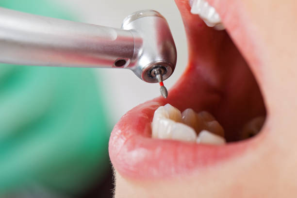 Best Emergency Treatment for Dental Infections or Abscesses in Five Points, NC
